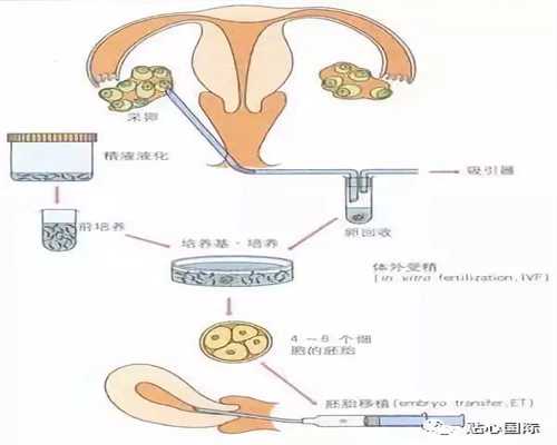 代孕最低价格_宫外孕胚胎死亡怎么办